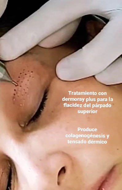 Dermoray Plus